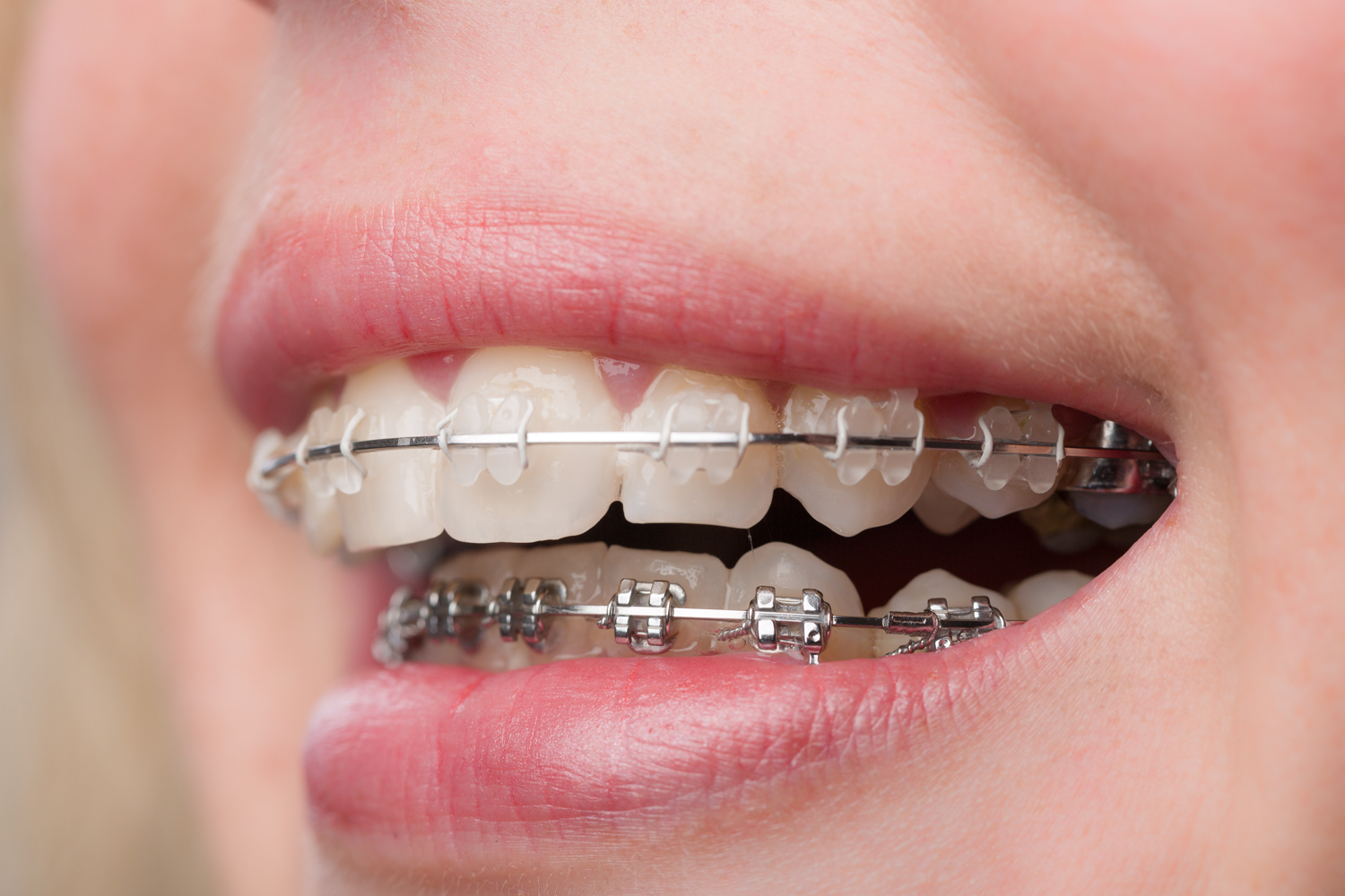 Yetişkinlik Döneminde Diş Teli Tedavisi İle Yaşam Kalitenizi Artırın
