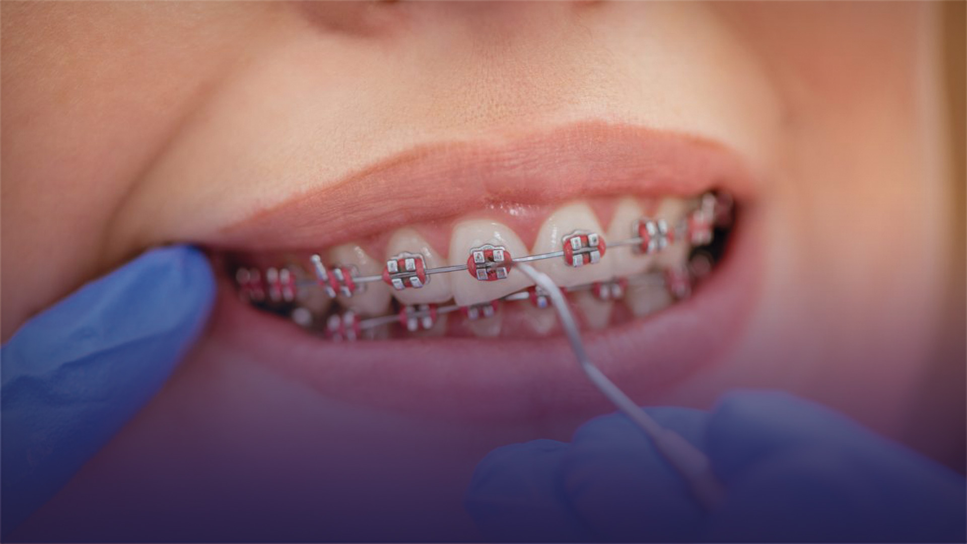 Diş Teliyle Nasıl Diş Fırçalanır?