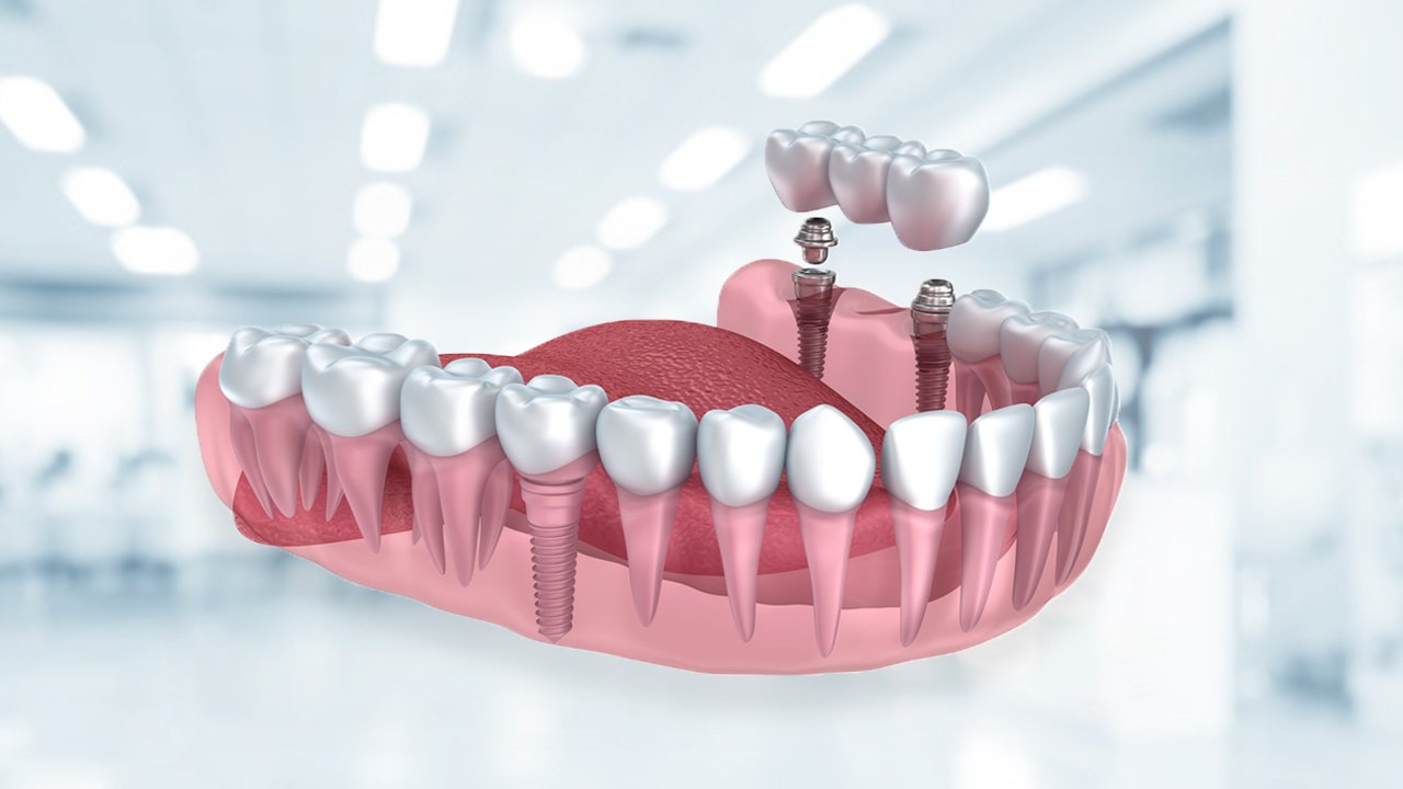 implant fiyatları