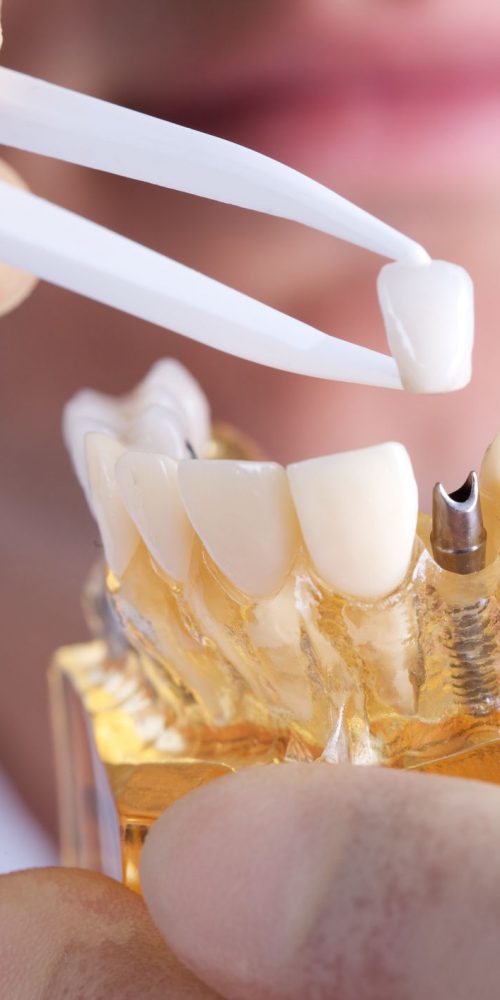 implant tedavisi