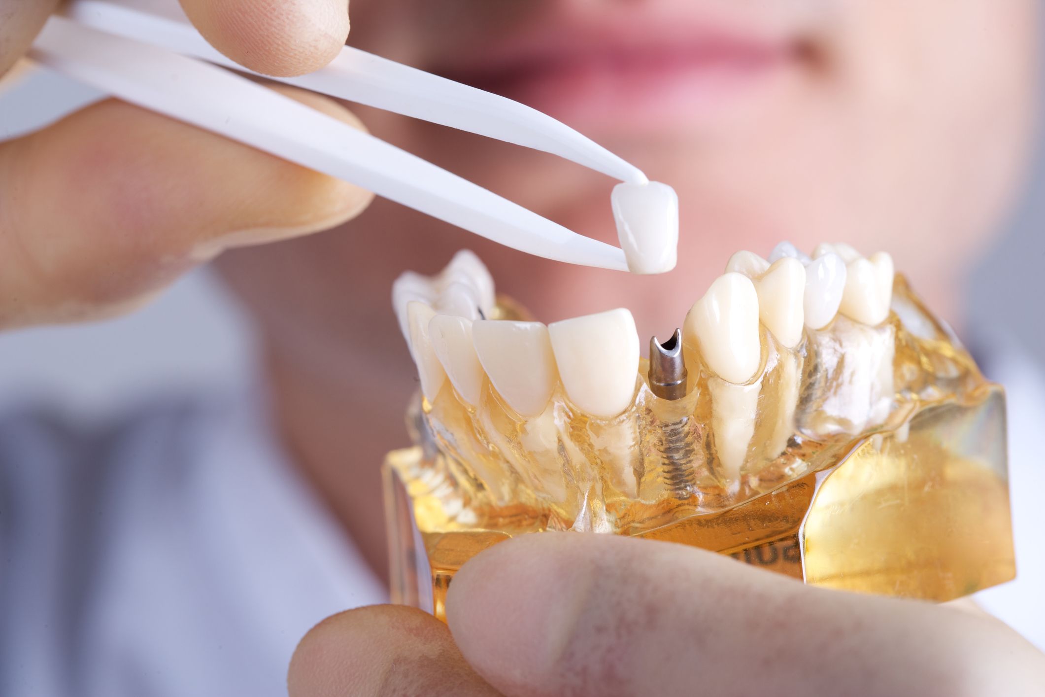 İmplant Diş Bakımı Nasıl Yapılır?