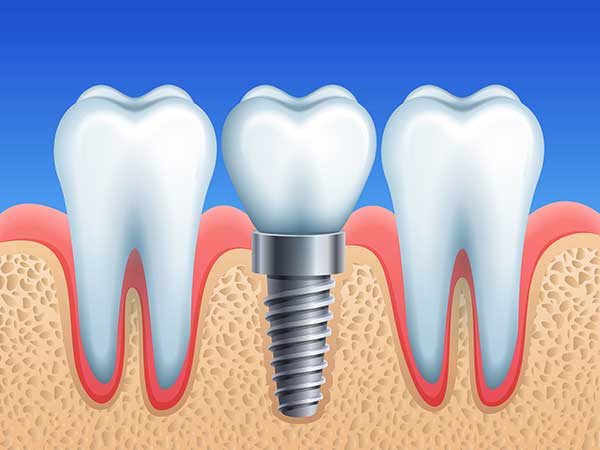 Implant Diş Çürür Mü?