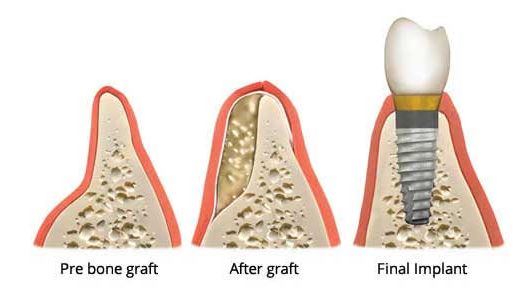 kemik estetiklerinde implant