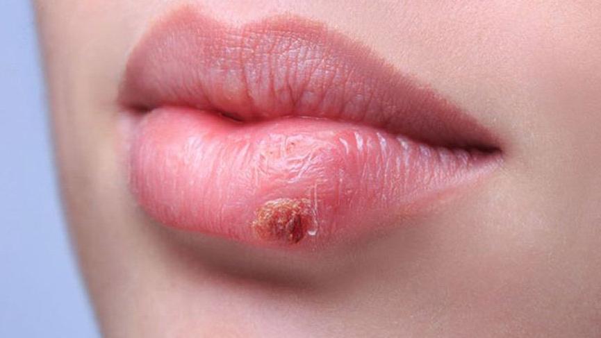 Uçuk (Herpes Simplex) Nedir?