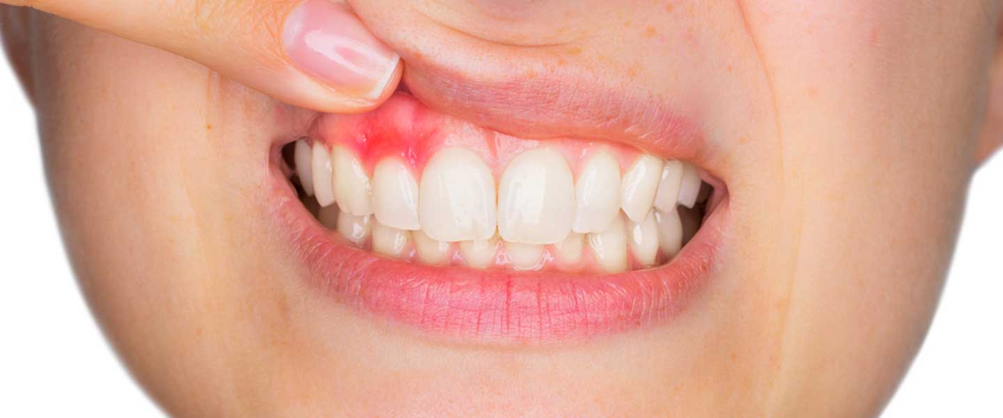 Diş Apsesi Belirtileri Nelerdir, Diş Apsesi Tedavi Süreçlerini Çok Etkiler Mi?