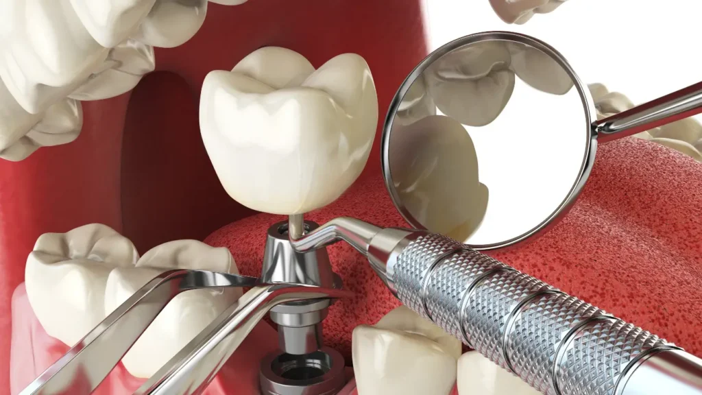 düşen-implant-geri-takılır-mı
