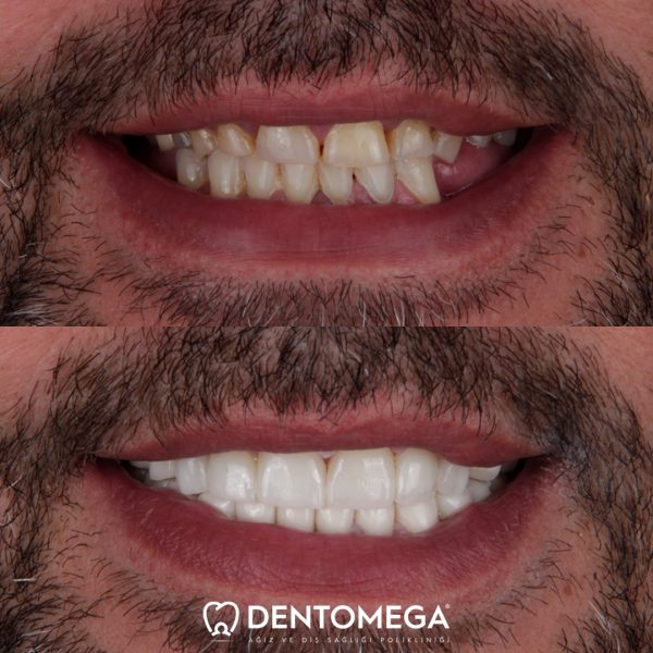 dentomega-before-after-1