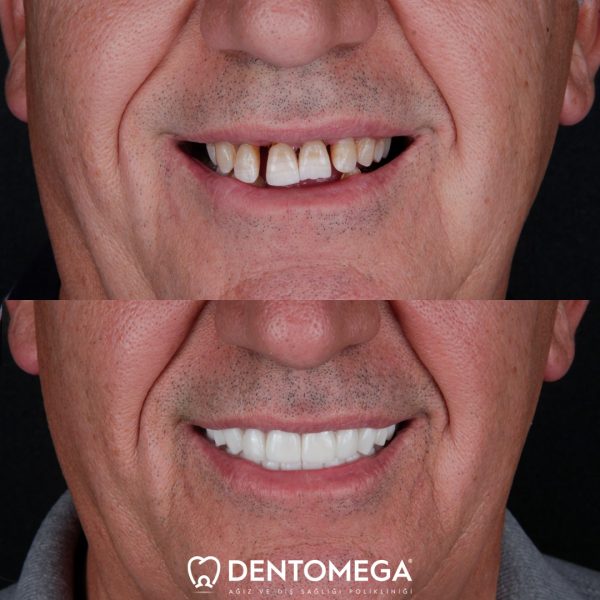 dentomega-before-after-2