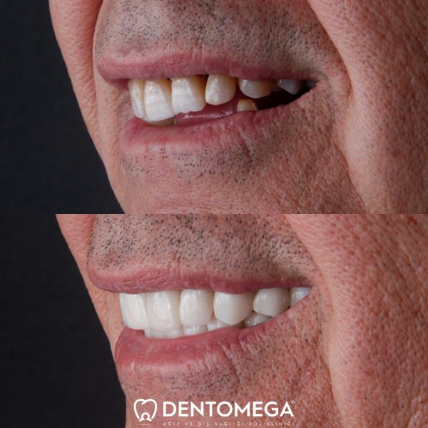 dentomega-before-after-3