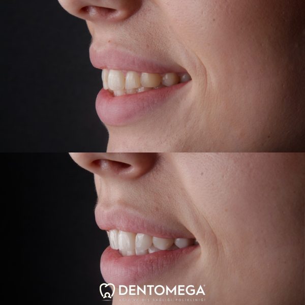 dentomega-before-after-4