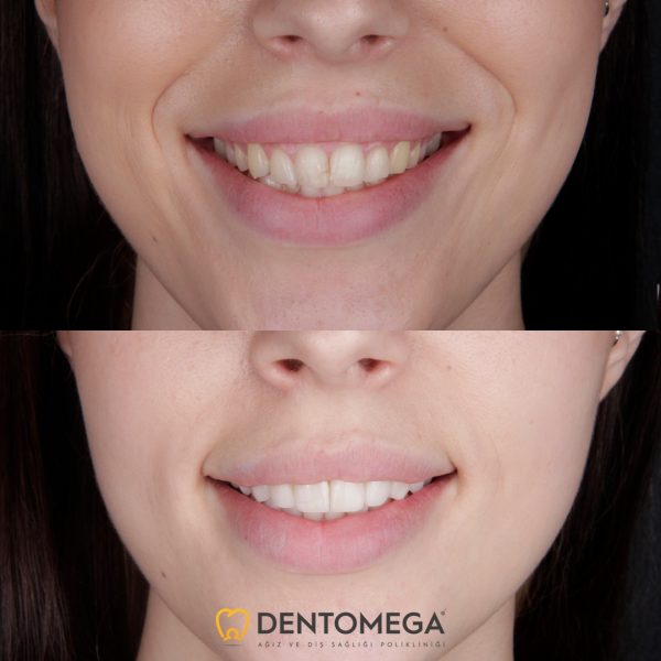 dentomega-before-after-5