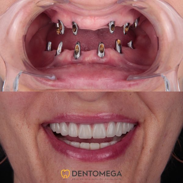 dentomega-before-after-6