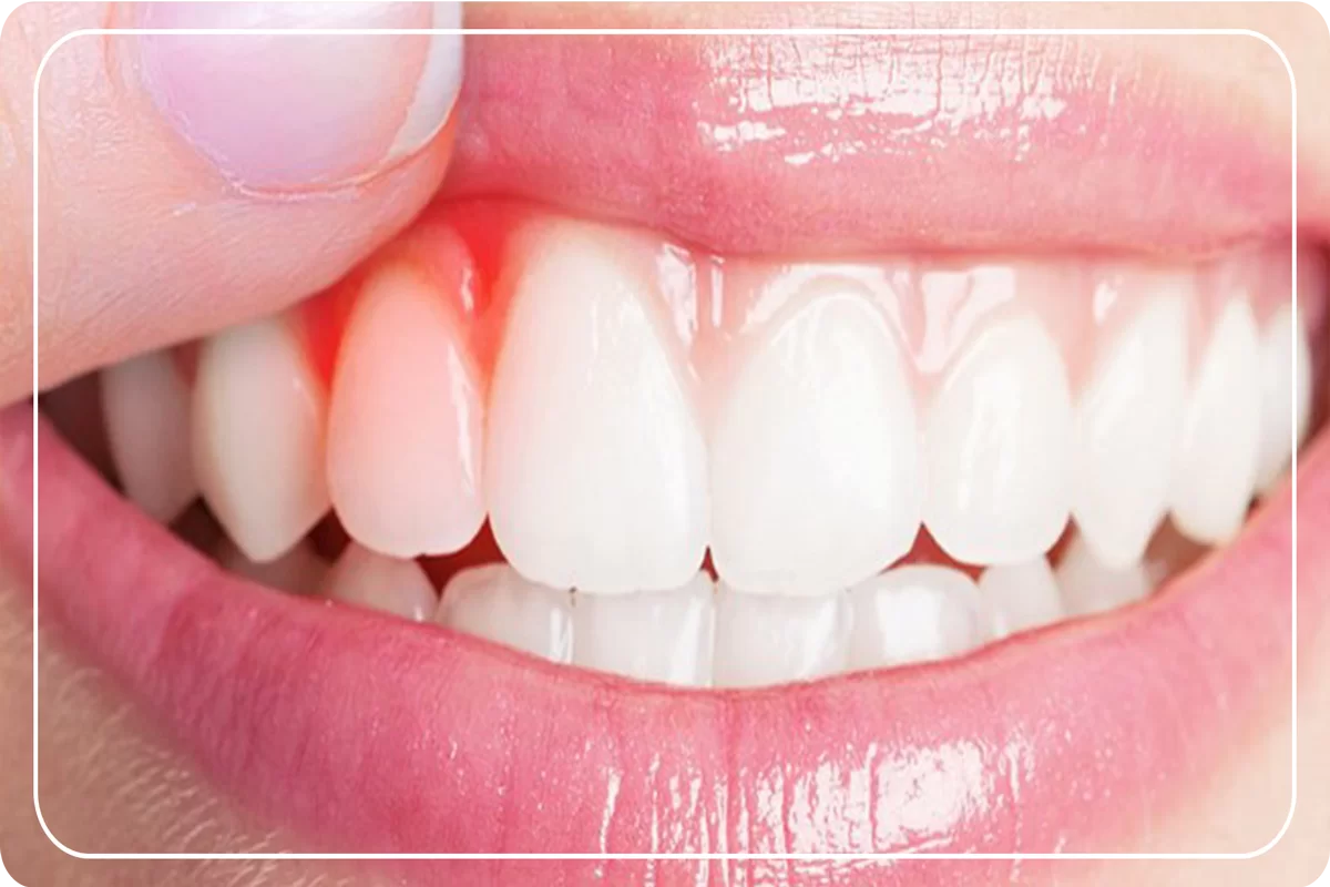 Diş Enfeksiyonu Nedir ve Nedenleri
