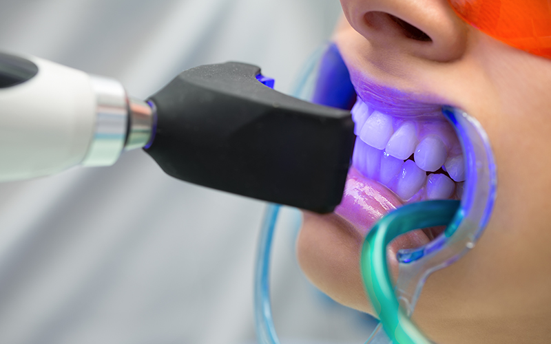 Diş Beyazlatma Yöntemleri ve Tedavisi