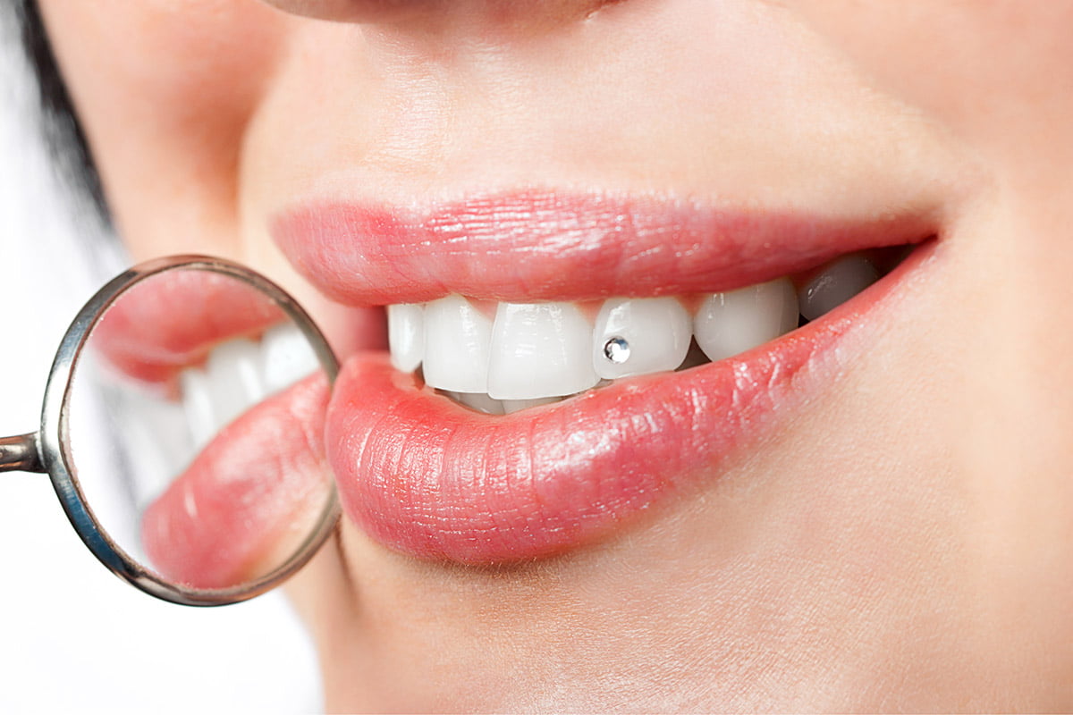 Diş Pırlantası Nedir ve Nasıl Takılır