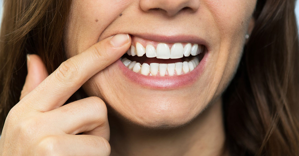 Diş Etinin Morarması Normal Midir?