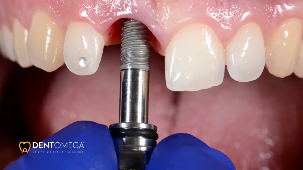 implantın tutup tutmadığı nasıl anlaşılır
