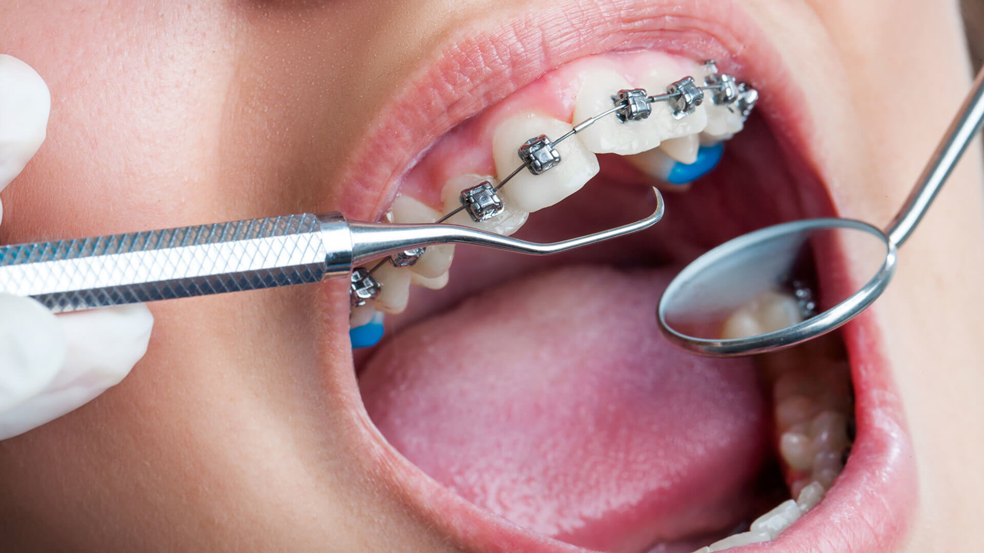 Diş Teli Çeşitleri Nelerdir?