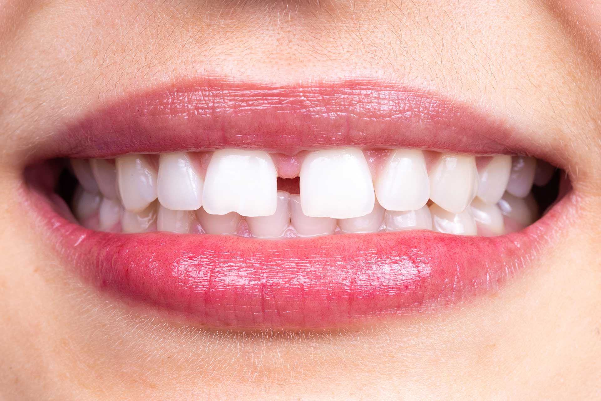 Diş Arası Boşluk Kapatma Tedavileri Nelerdir?