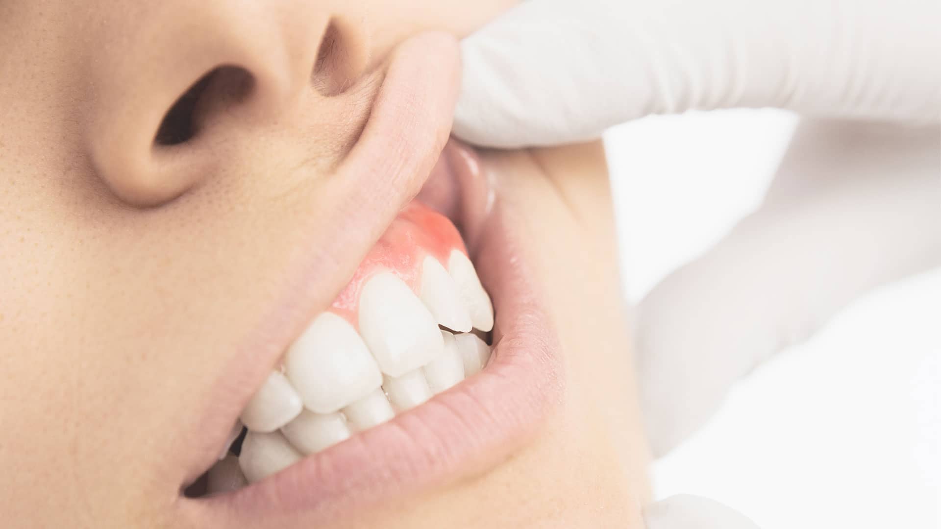 Diş Eti Sağlığına Zarar Veren Etkenler Nelerdir?