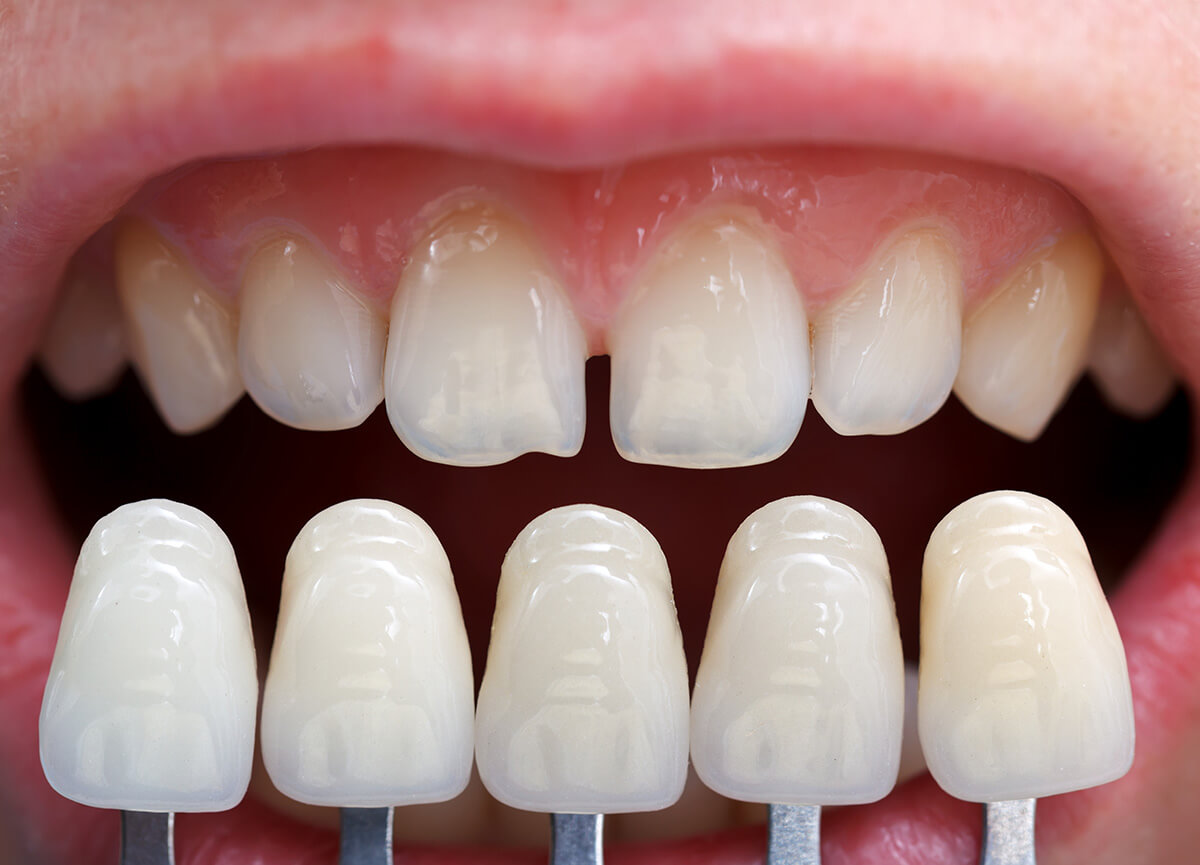Diş Kaplama Çeşitleri Nelerdir?