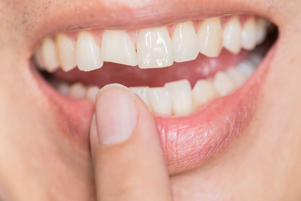 Diş Travması Nedir?
