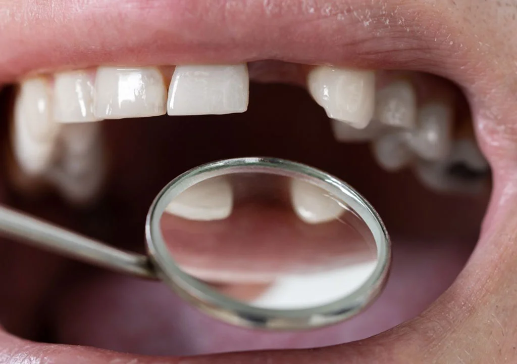 Ağızda Diş Eksikliği Konuşmayı Etkiler Mi?