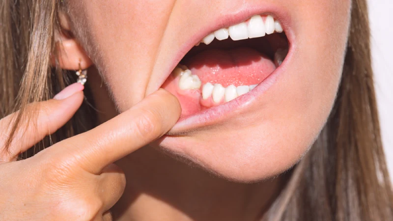 Çekilen Dişin Yerine Diş Yapılmazsa Ne Olur?