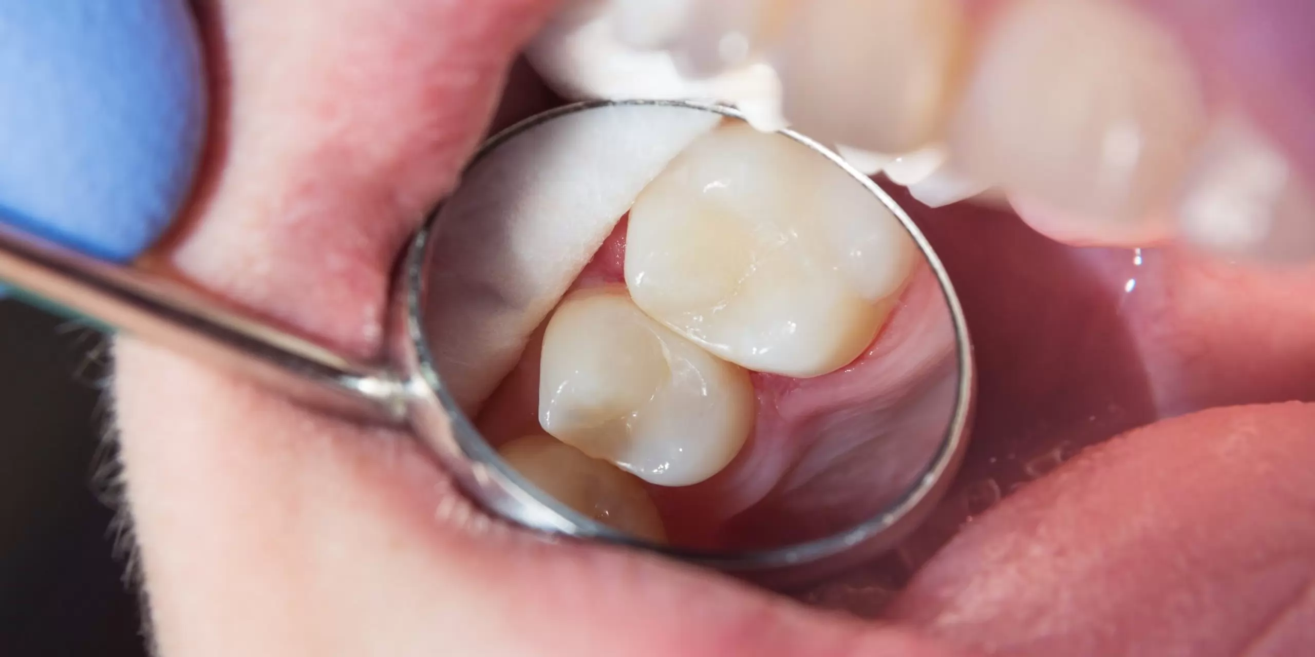 Diş Dolgusu Yapılınca Nelere Dikkat Edilmeli?