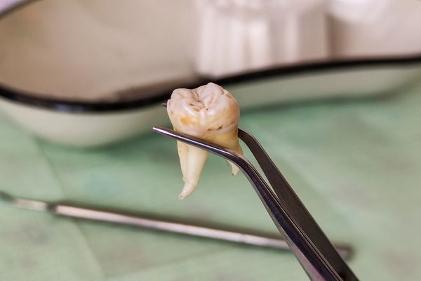 20’lik Diş Çekimi: Diş Hekimliğinde Önemli Bir Prosedür
