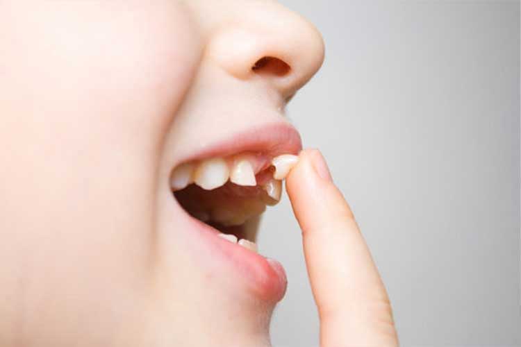 Çocuklarda Diş Dökülmeleri Ne Zaman Başlar?