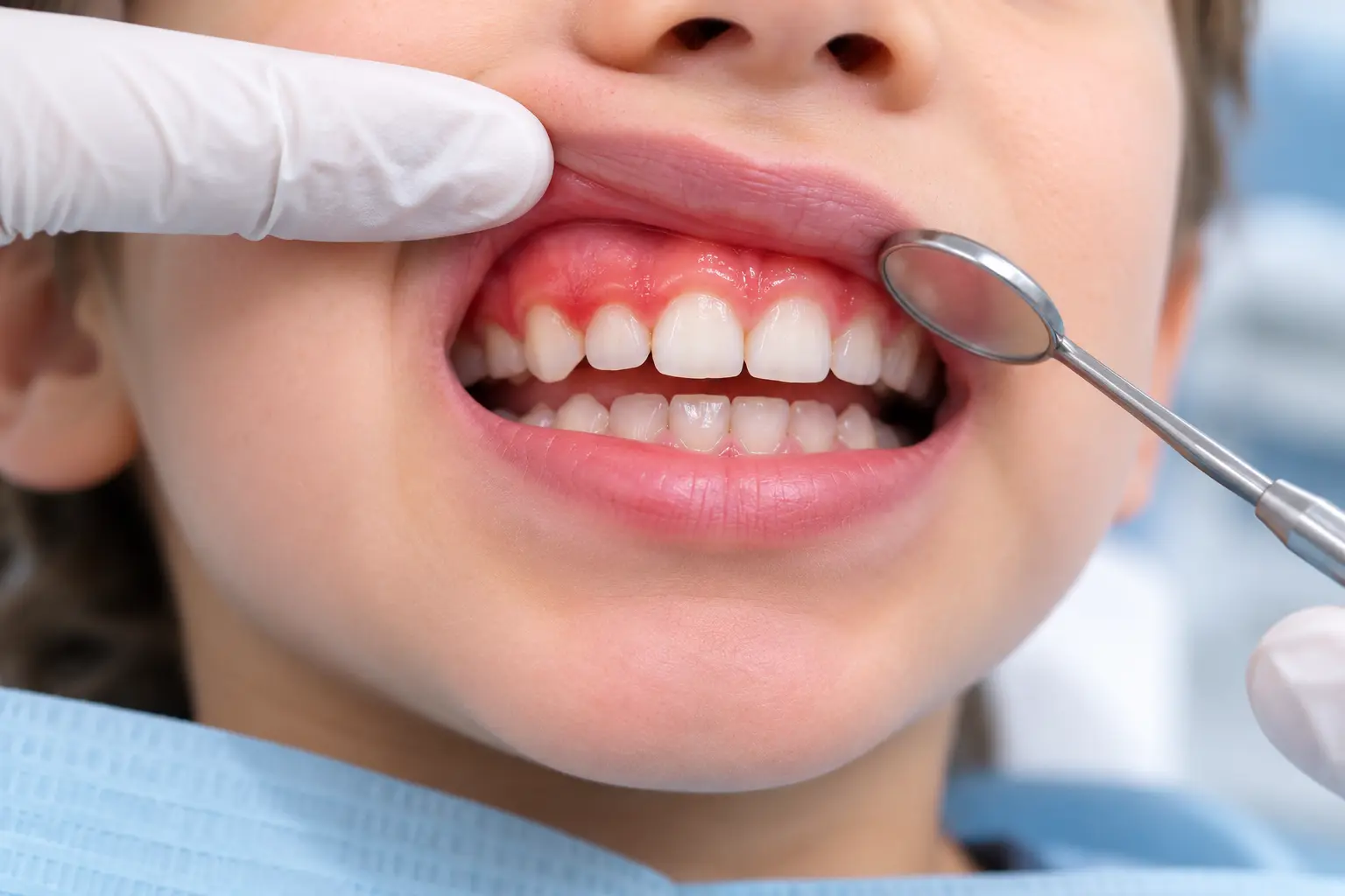 Çocuklarda Diş Eti İltihabı (Gingivitis) ve Sebepleri