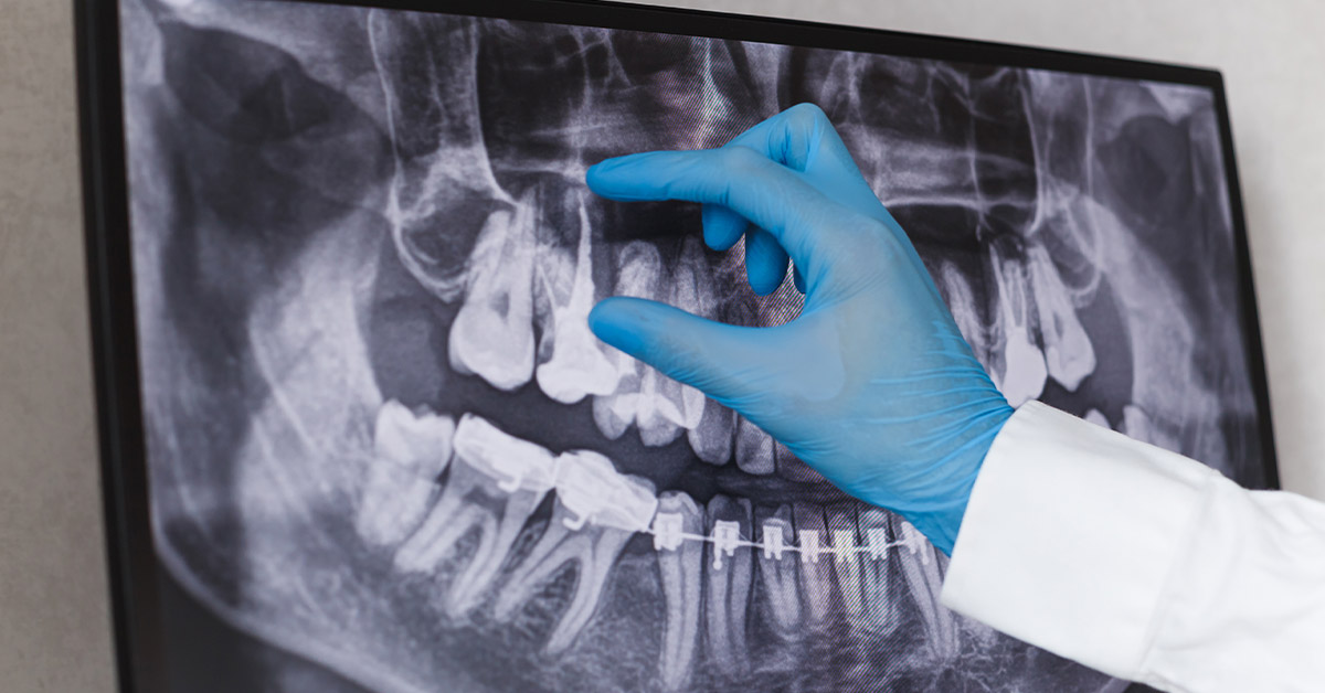 Kanal Tedavisi: Dişlerin Kurtuluş Yolu