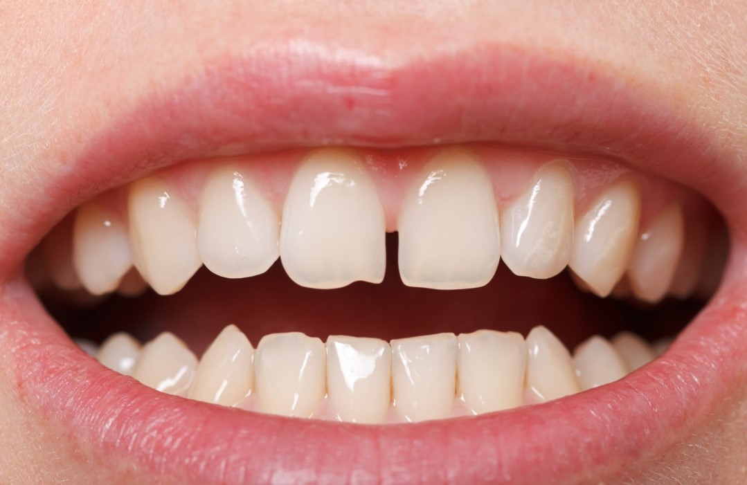 Diş Arası Boşluk Kapatma Yöntemleri Nelerdir?