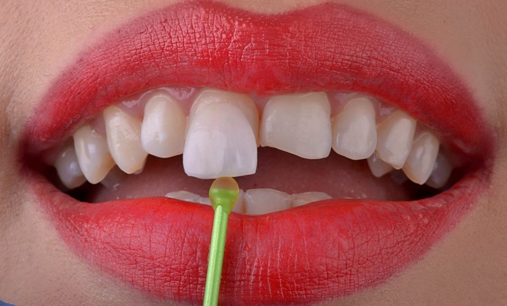 Yaprak Diş Kaplama: Doğal Gülüşünüz İçin Mükemmel Çözüm