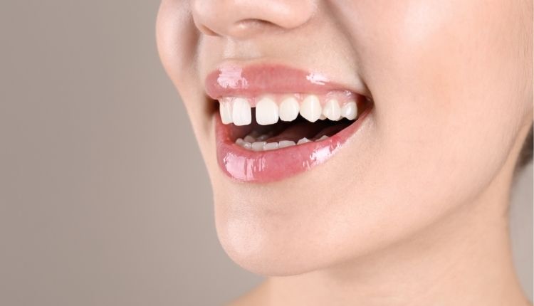 Başlık: Diş Estetiğinde Harika Bir Çözüm: Bonding Uygulaması