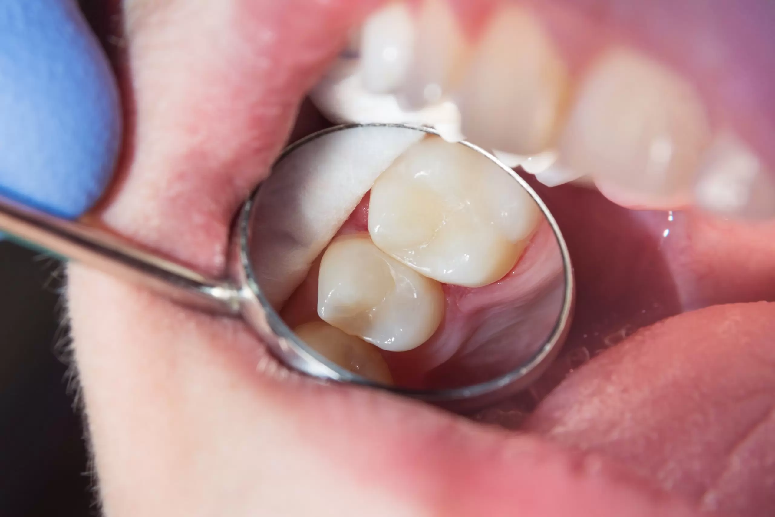 Diş Dolgusu Nasıl Yapılır?