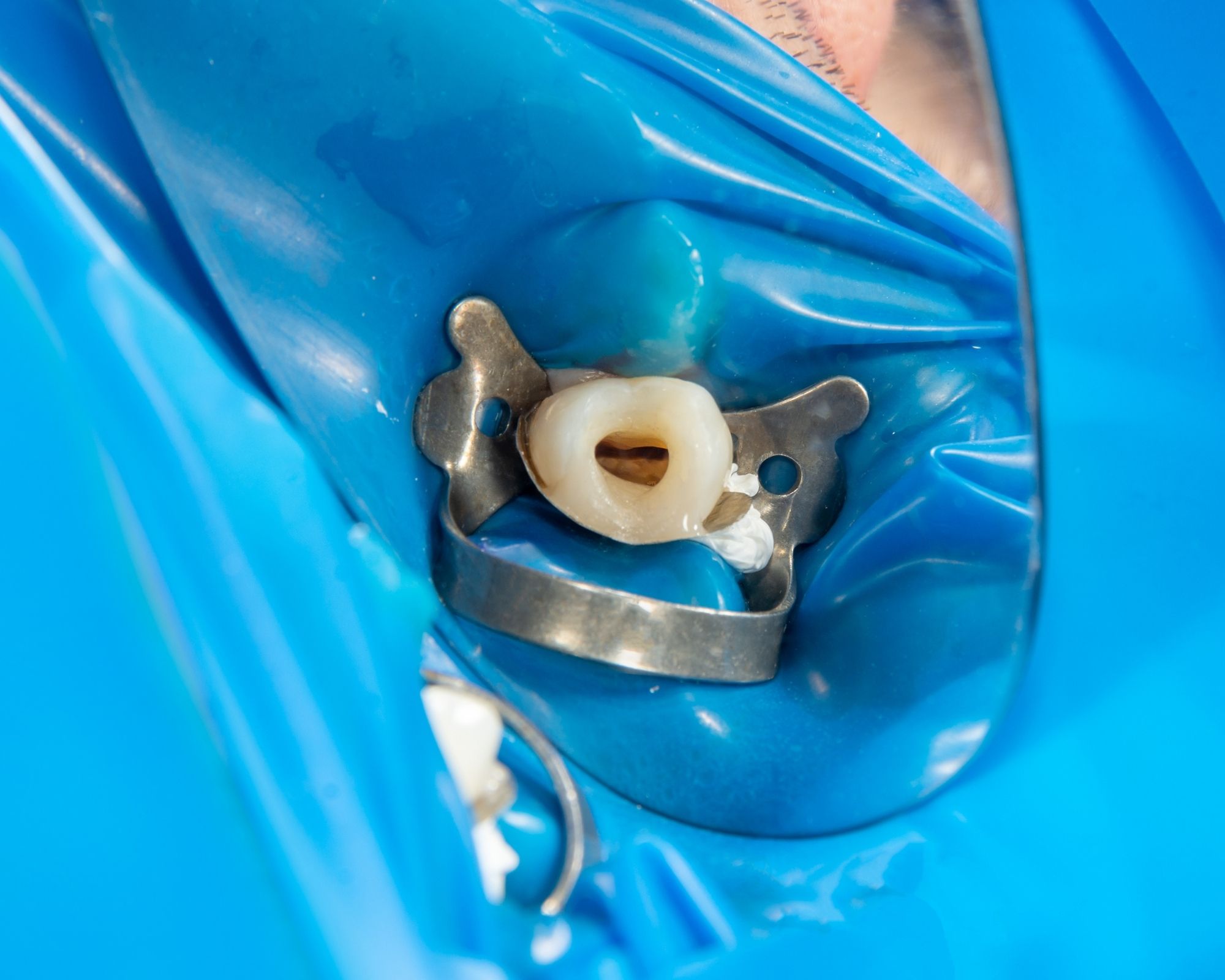 Kanal Tedavisi Sonrası Dişler Neden Kararır?