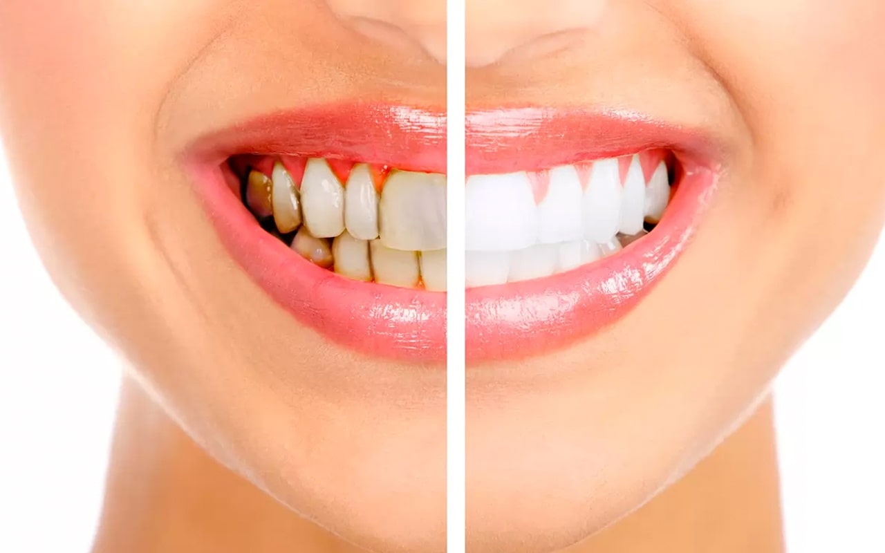 Diş Taşı Temizliği Sonrası Her Leke Çıkar Mı?