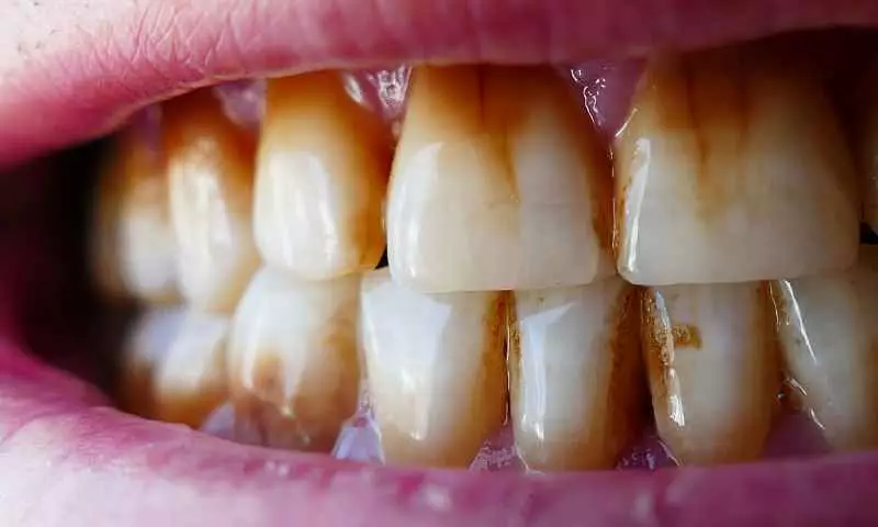 Her Diş Lekesi Diş Çürüğü Müdür?