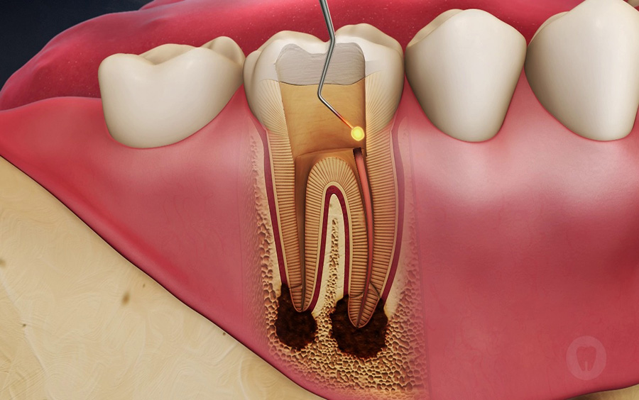 Kanal Tedavisi Dişi Kurtarır Mı?