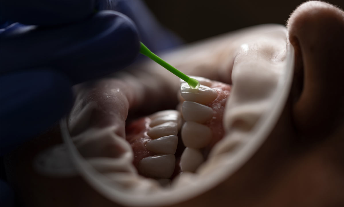 Diş Arası Boşluk Kapatma Tedavileri Nelerdir?
