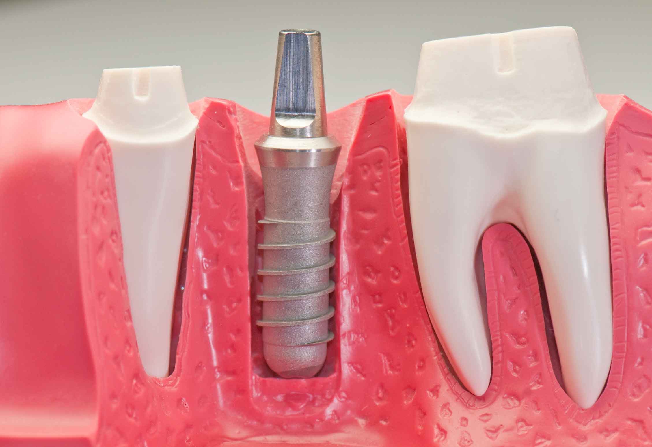 Kanser Hastaları Diş İmplantı Yaptırabilir Mi?