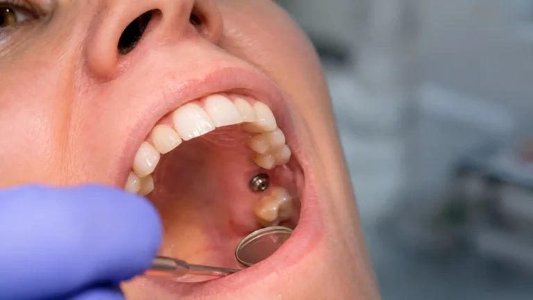 Sinüs Sarkması Varken İmplant Yapılabilir Mi