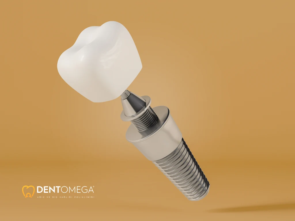 diş implantı alerji yapar mı