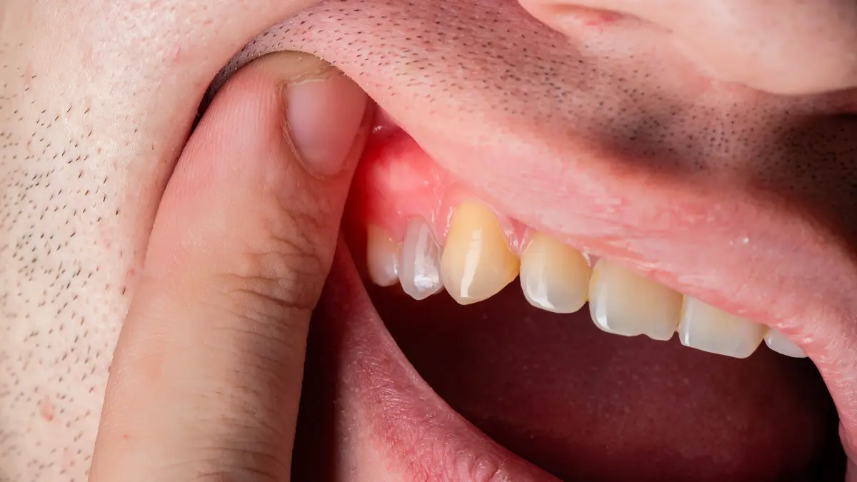 Dişler Neden Aşınmaya Başlar?
