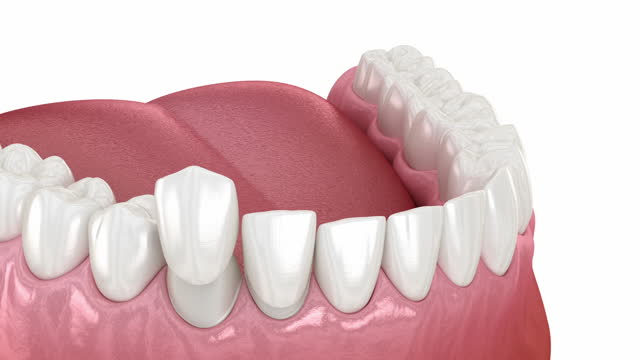 Non Prep Veneers Nedir?