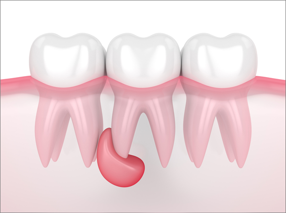 Diş Kisti Nedir? Diş Kisti Nasıl Tedavi Edilmelidir?