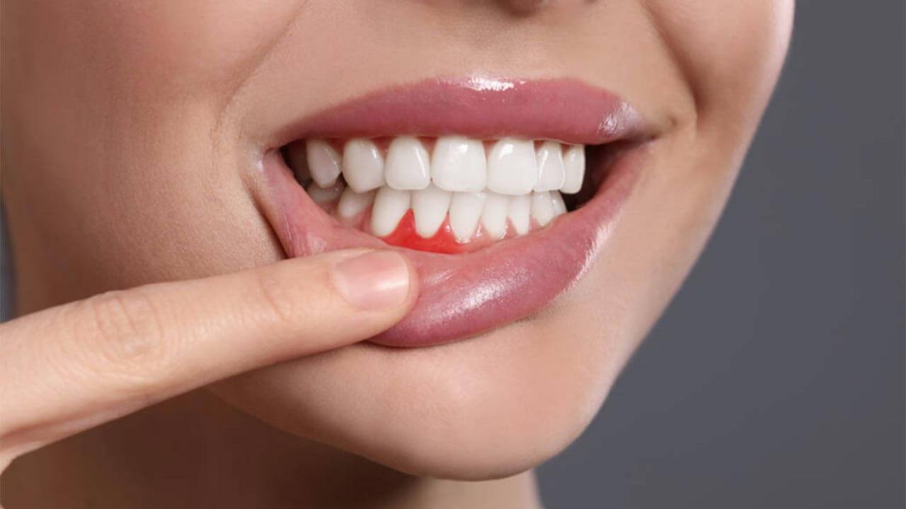 Diş Kökü İltihabı Nedir? Nasıl Tedavi Edilir?