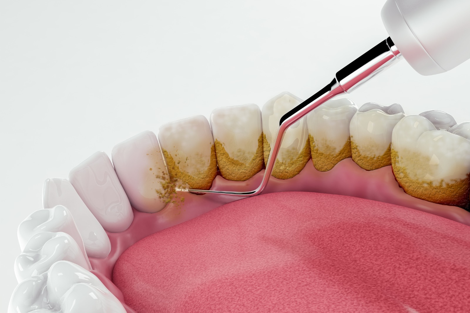 Diş Taşı Temizliği Hangi Aralıklarla Yapılmalıdır?